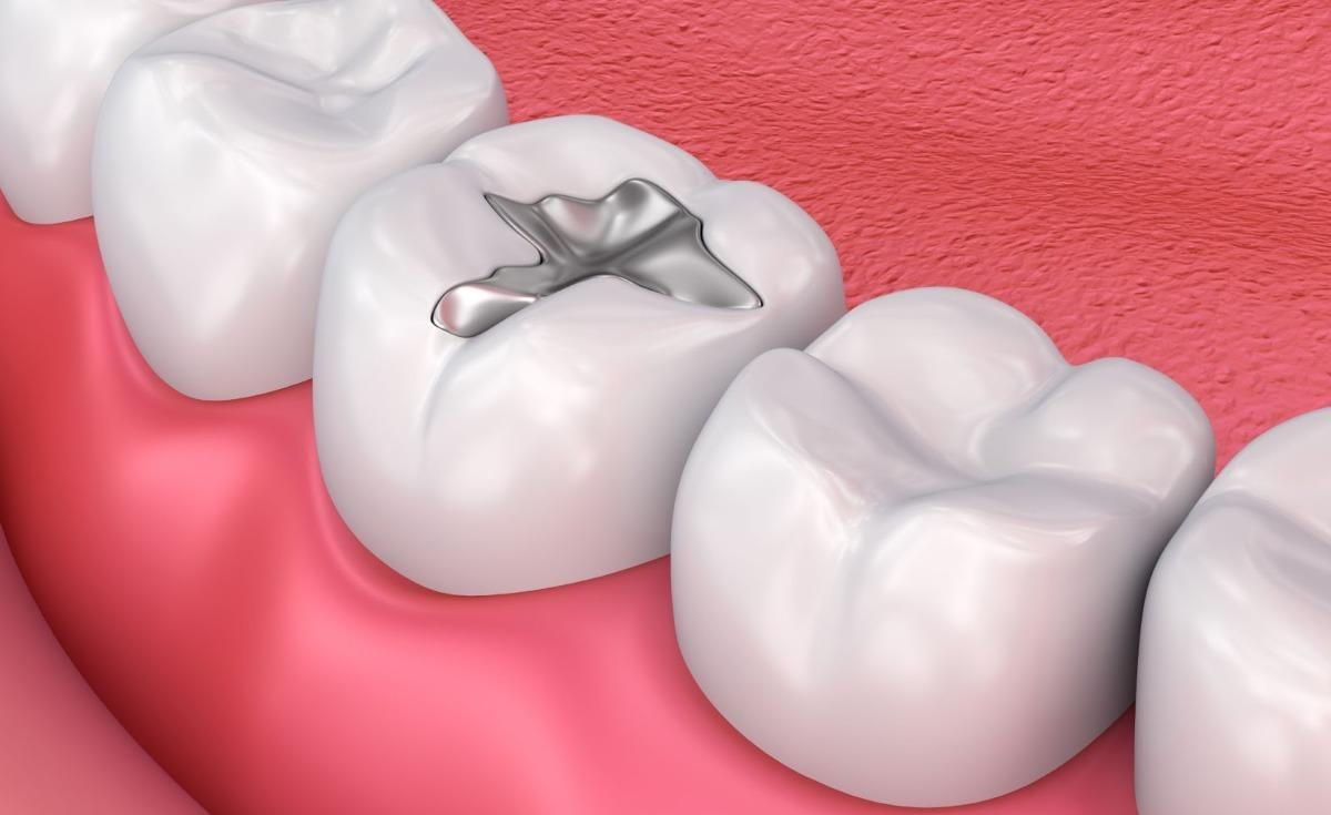 Aligner image 1
