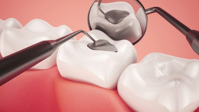 Aligner image 2