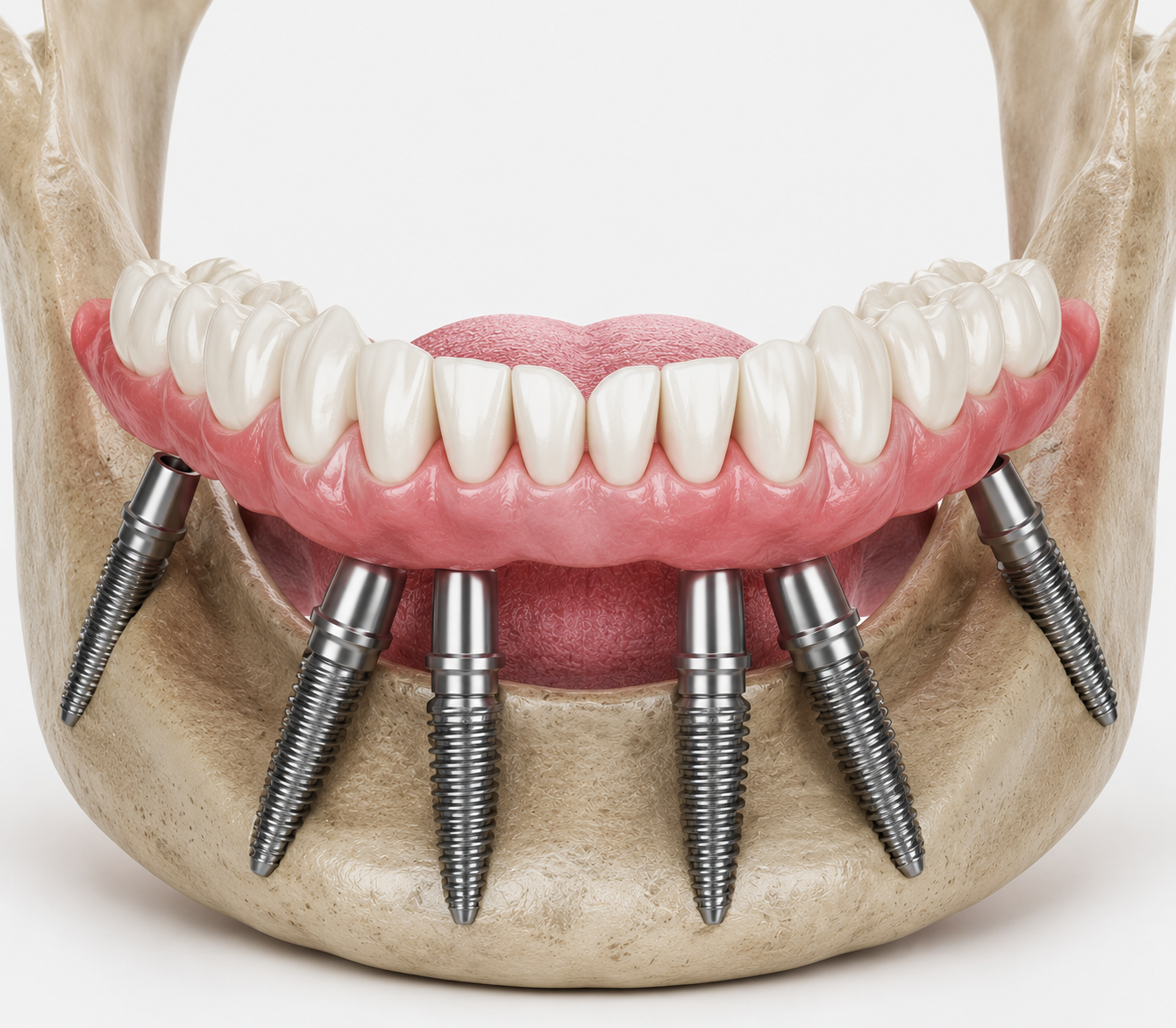 Aligner image 2