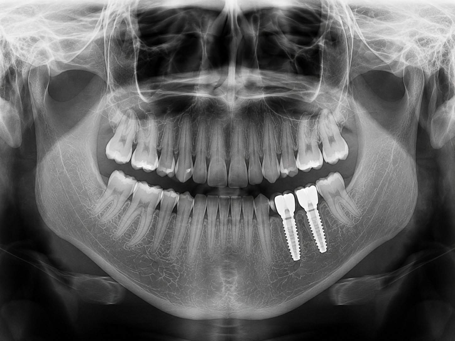 Implant image 2