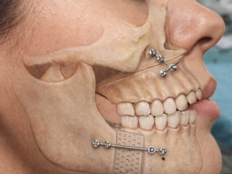 Aligner image 1