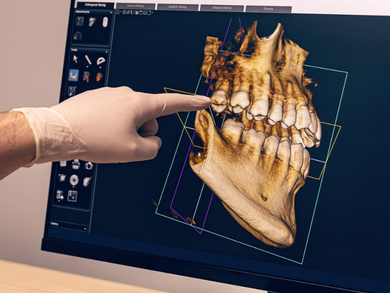 Aligner image 2