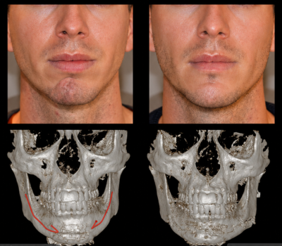Aligner image 1